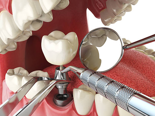 Best Broken or Chipped Tooth Repair in Hueytown, AL